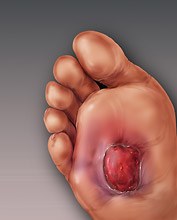 Diabetic-foot-ulcer