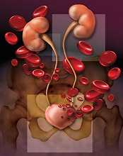 hematuria